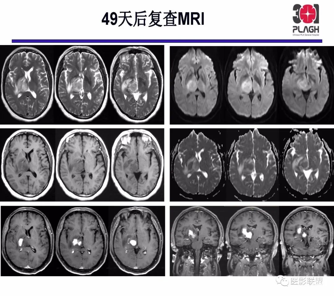 影像PPT - 【PPT】不典型原发中枢神经系统淋巴瘤影像诊断思路-26