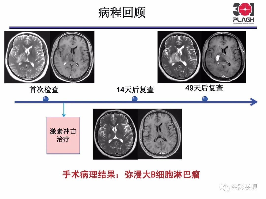 影像PPT - 【PPT】不典型原发中枢神经系统淋巴瘤影像诊断思路-27