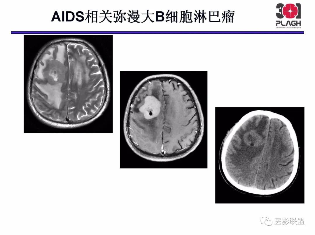 影像PPT - 【PPT】不典型原发中枢神经系统淋巴瘤影像诊断思路-29