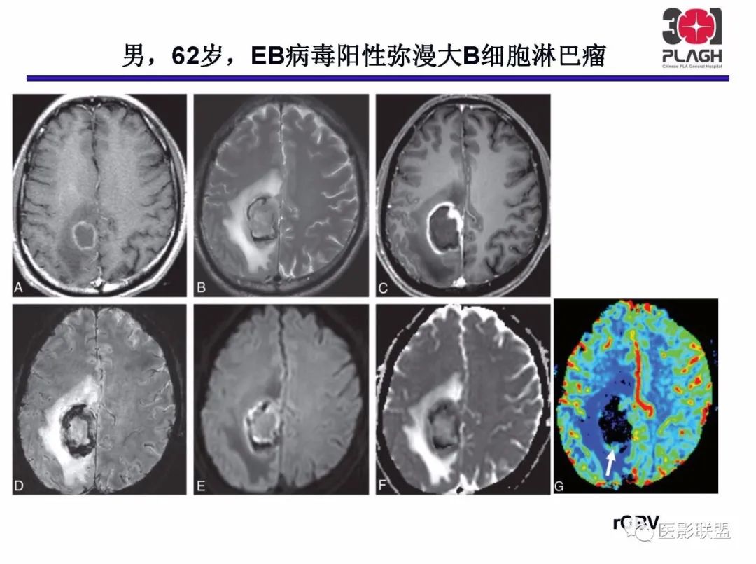 影像PPT - 【PPT】不典型原发中枢神经系统淋巴瘤影像诊断思路-31