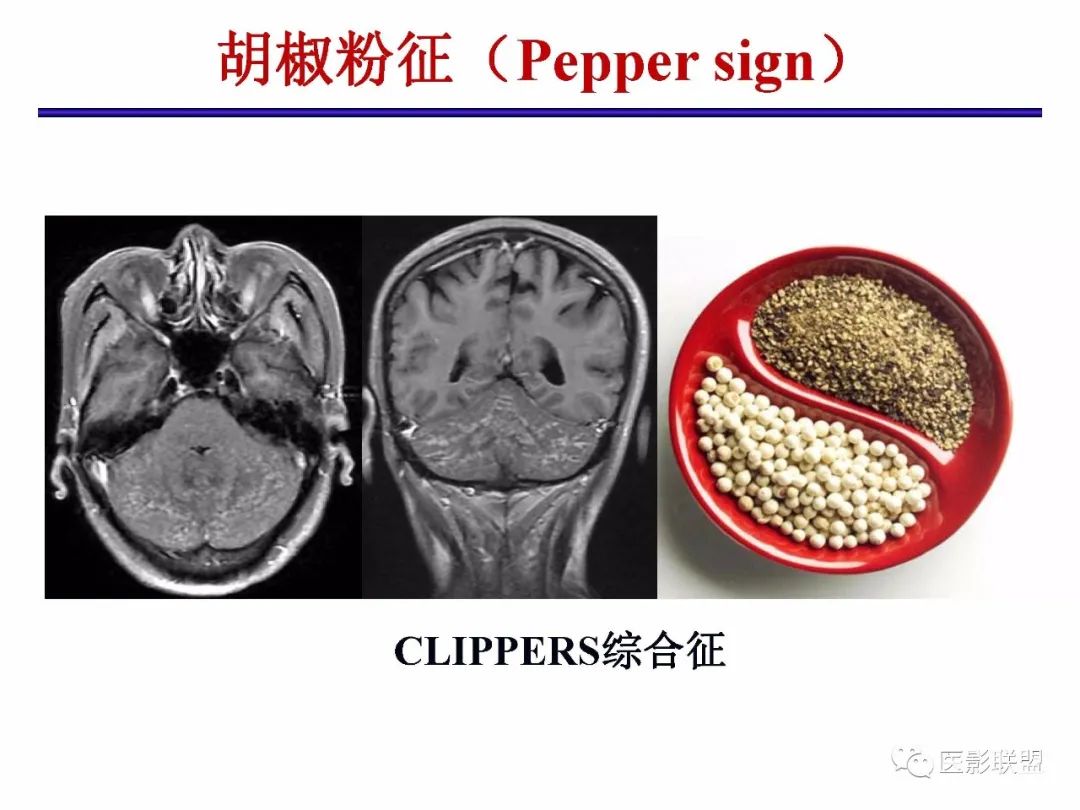 影像PPT - 【PPT】不典型原发中枢神经系统淋巴瘤影像诊断思路-36