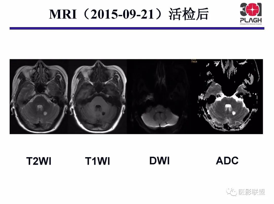 影像PPT - 【PPT】不典型原发中枢神经系统淋巴瘤影像诊断思路-38