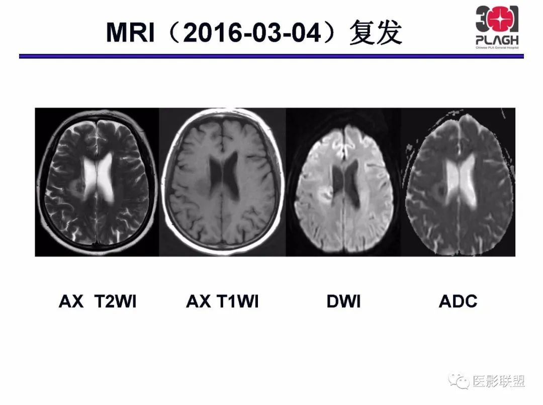 影像PPT - 【PPT】不典型原发中枢神经系统淋巴瘤影像诊断思路-40