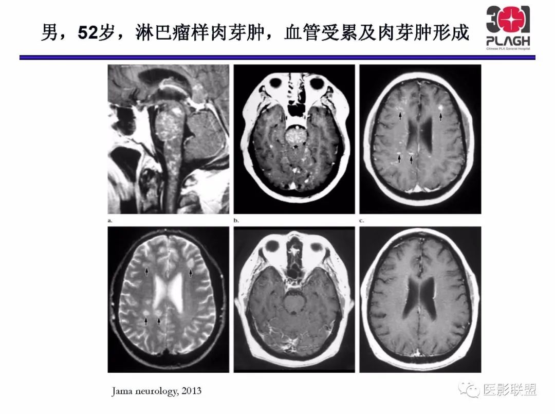 影像PPT - 【PPT】不典型原发中枢神经系统淋巴瘤影像诊断思路-46