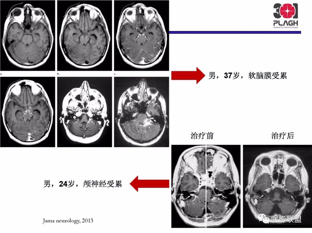 影像PPT - 【PPT】不典型原发中枢神经系统淋巴瘤影像诊断思路-47