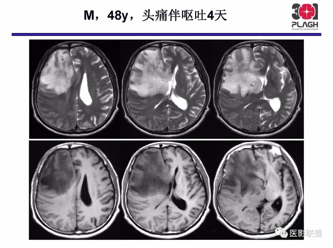 影像PPT - 【PPT】不典型原发中枢神经系统淋巴瘤影像诊断思路-49
