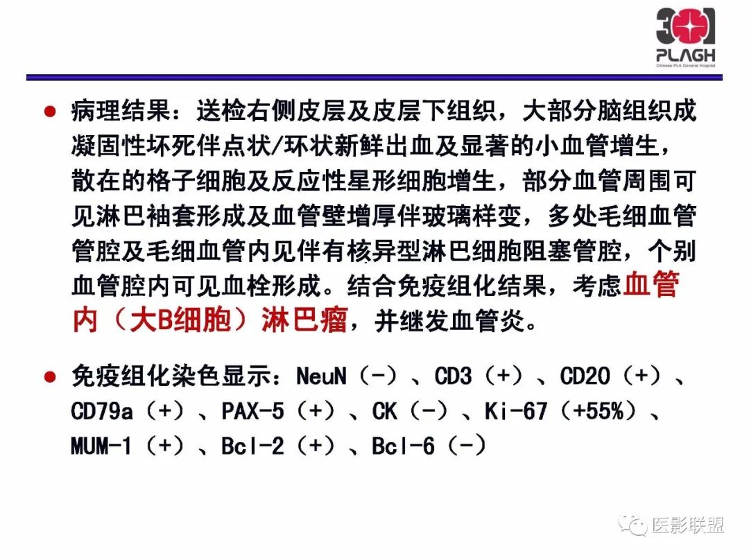 影像PPT - 【PPT】不典型原发中枢神经系统淋巴瘤影像诊断思路-52