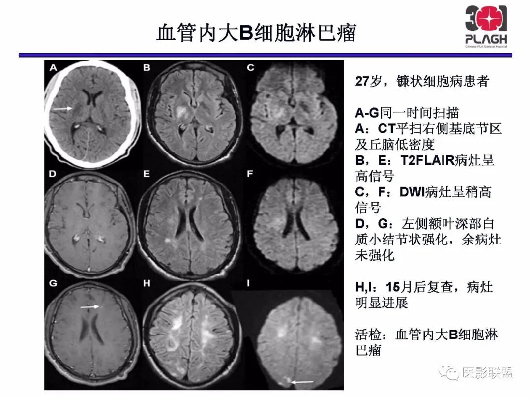 影像PPT - 【PPT】不典型原发中枢神经系统淋巴瘤影像诊断思路-53