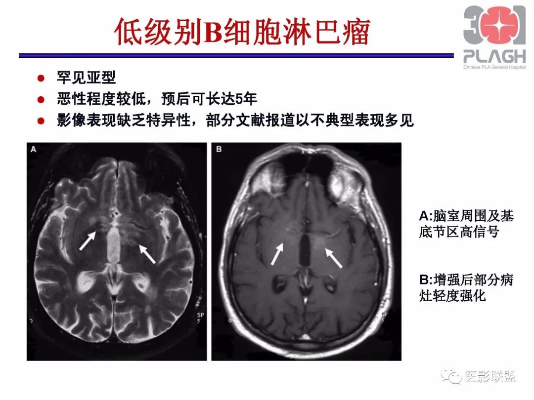 影像PPT - 【PPT】不典型原发中枢神经系统淋巴瘤影像诊断思路-54