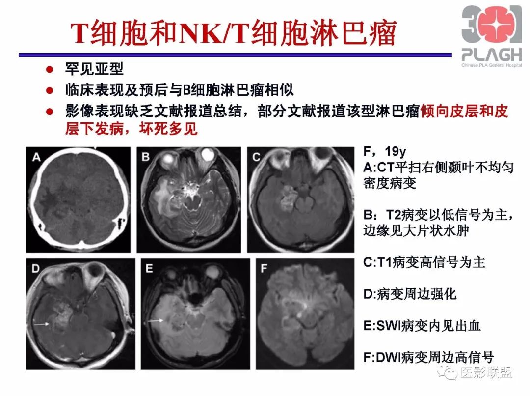 影像PPT - 【PPT】不典型原发中枢神经系统淋巴瘤影像诊断思路-56