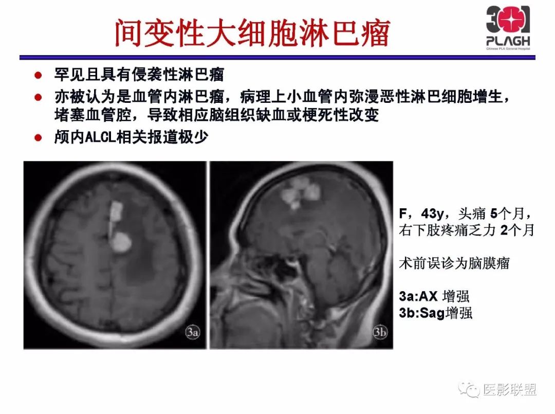 影像PPT - 【PPT】不典型原发中枢神经系统淋巴瘤影像诊断思路-57