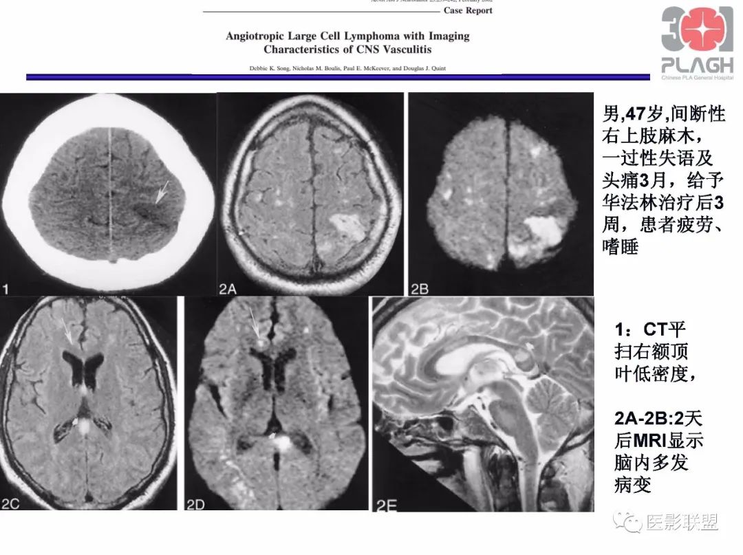 影像PPT - 【PPT】不典型原发中枢神经系统淋巴瘤影像诊断思路-58