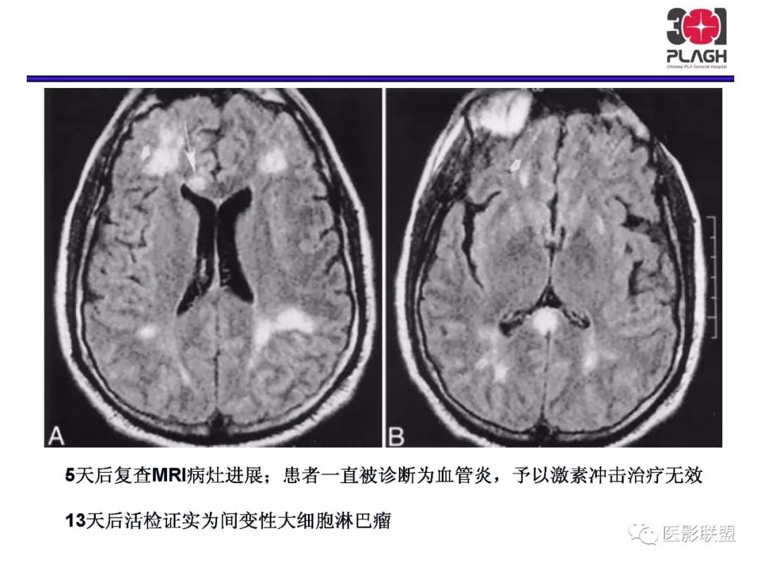 影像PPT - 【PPT】不典型原发中枢神经系统淋巴瘤影像诊断思路-59