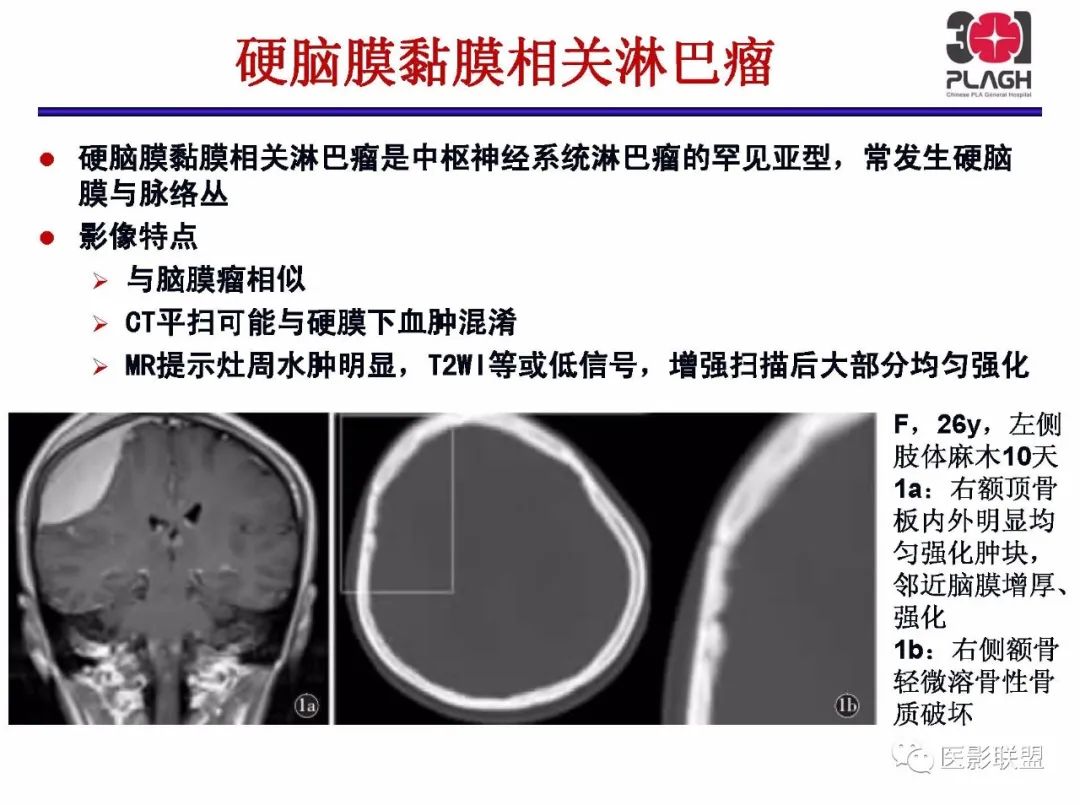 影像PPT - 【PPT】不典型原发中枢神经系统淋巴瘤影像诊断思路-60