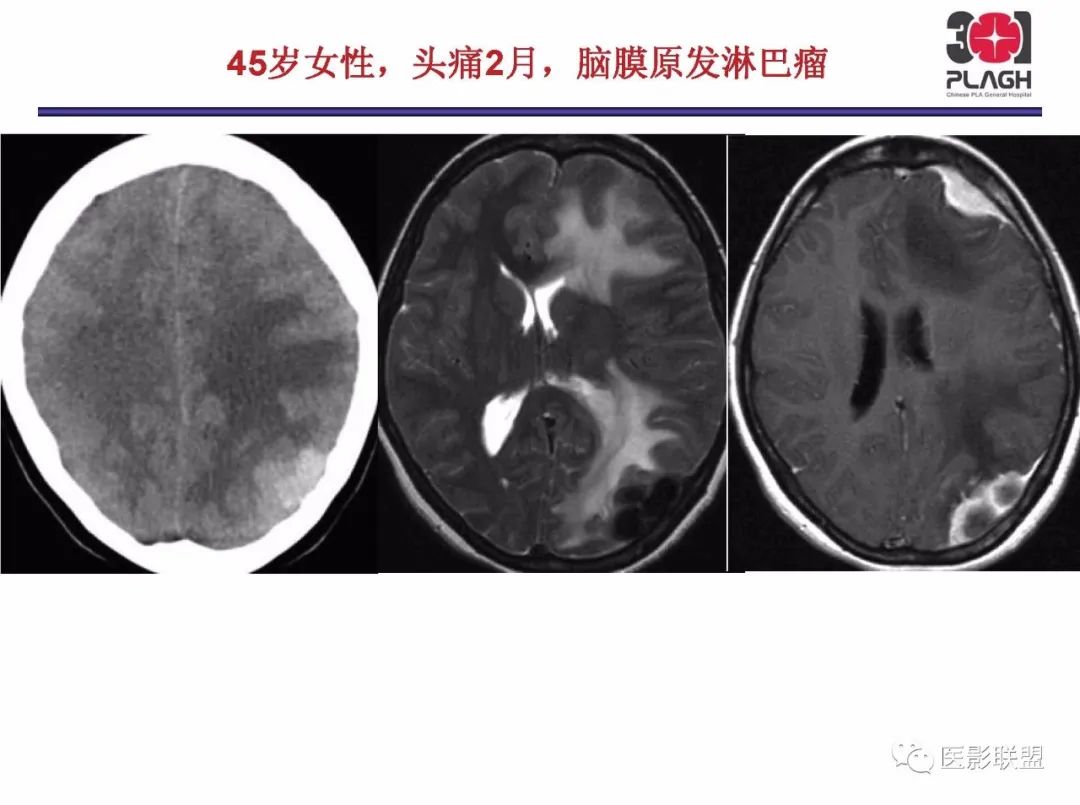 影像PPT - 【PPT】不典型原发中枢神经系统淋巴瘤影像诊断思路-62