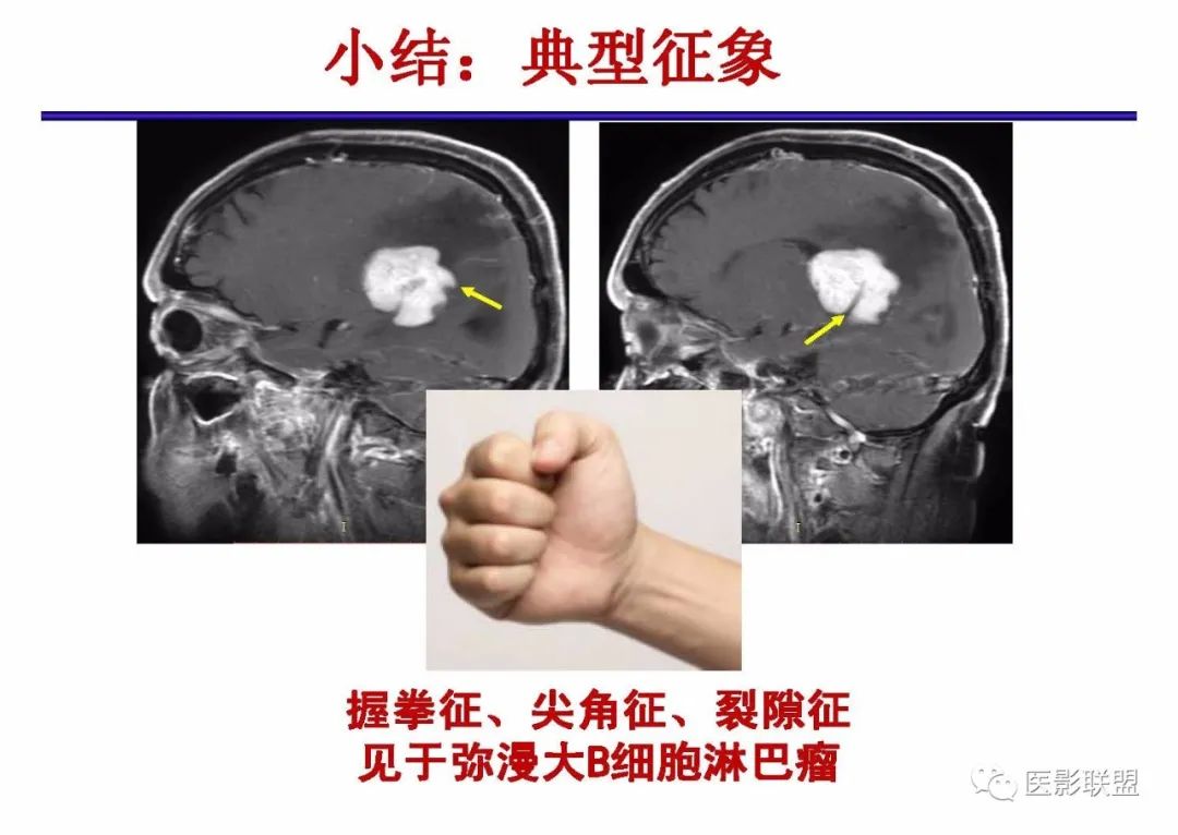影像PPT - 【PPT】不典型原发中枢神经系统淋巴瘤影像诊断思路-63