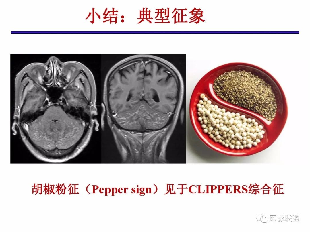 影像PPT - 【PPT】不典型原发中枢神经系统淋巴瘤影像诊断思路-64