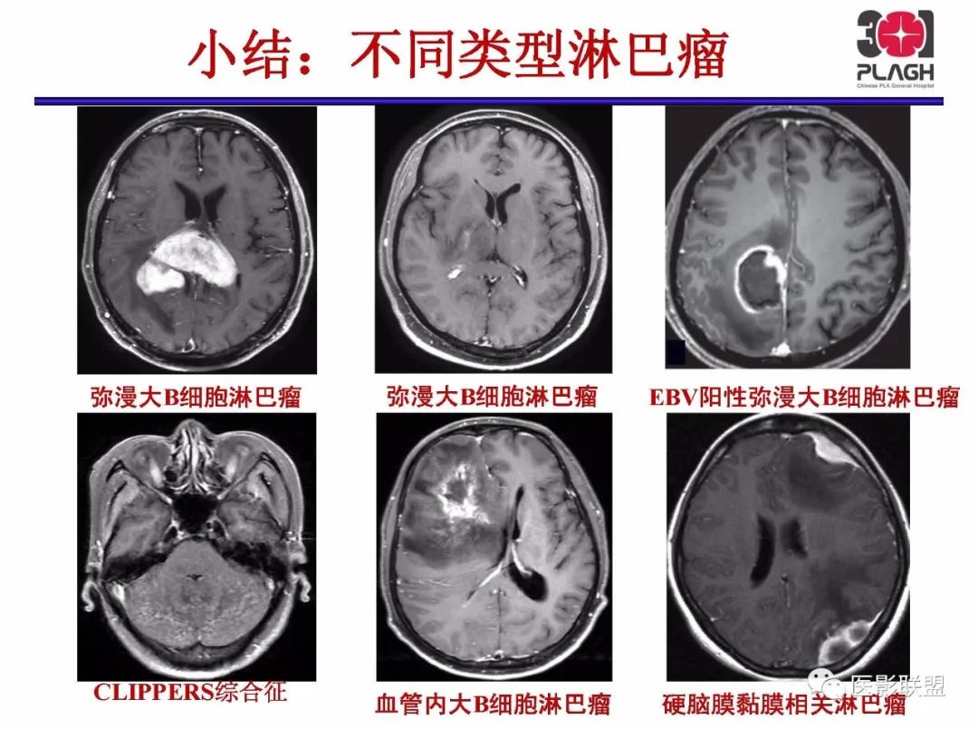 影像PPT - 【PPT】不典型原发中枢神经系统淋巴瘤影像诊断思路-65