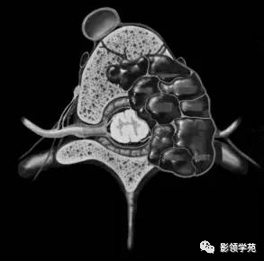影像PPT - 动脉瘤样骨囊肿影像学解析-1 影像PPT - 动脉瘤样骨囊肿影像学解析-1