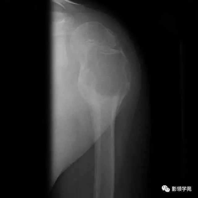 影像PPT - 动脉瘤样骨囊肿影像学解析-3 影像PPT - 动脉瘤样骨囊肿影像学解析-3