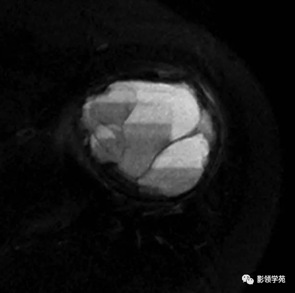 影像PPT - 动脉瘤样骨囊肿影像学解析-4 影像PPT - 动脉瘤样骨囊肿影像学解析-4