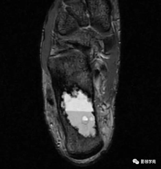 影像PPT - 动脉瘤样骨囊肿影像学解析-8 影像PPT - 动脉瘤样骨囊肿影像学解析-8