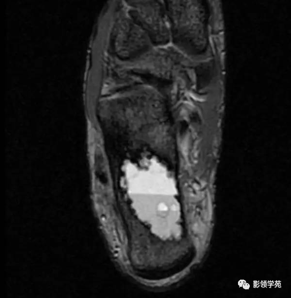 影像PPT - 动脉瘤样骨囊肿影像学解析-9 影像PPT - 动脉瘤样骨囊肿影像学解析-9