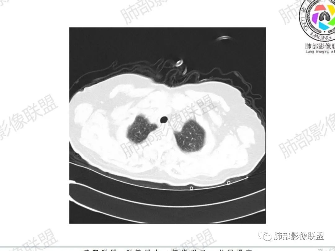 影像PPT - 【病例】气管腺样囊性癌1例CT影像讨论-5 影像PPT - 【病例】气管腺样囊性癌1例CT影像讨论-5