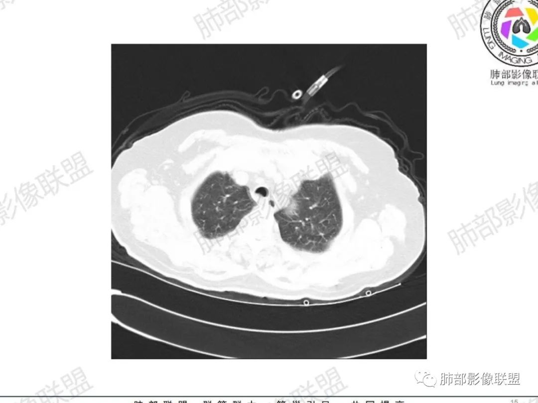 影像PPT - 【病例】气管腺样囊性癌1例CT影像讨论-8 影像PPT - 【病例】气管腺样囊性癌1例CT影像讨论-8