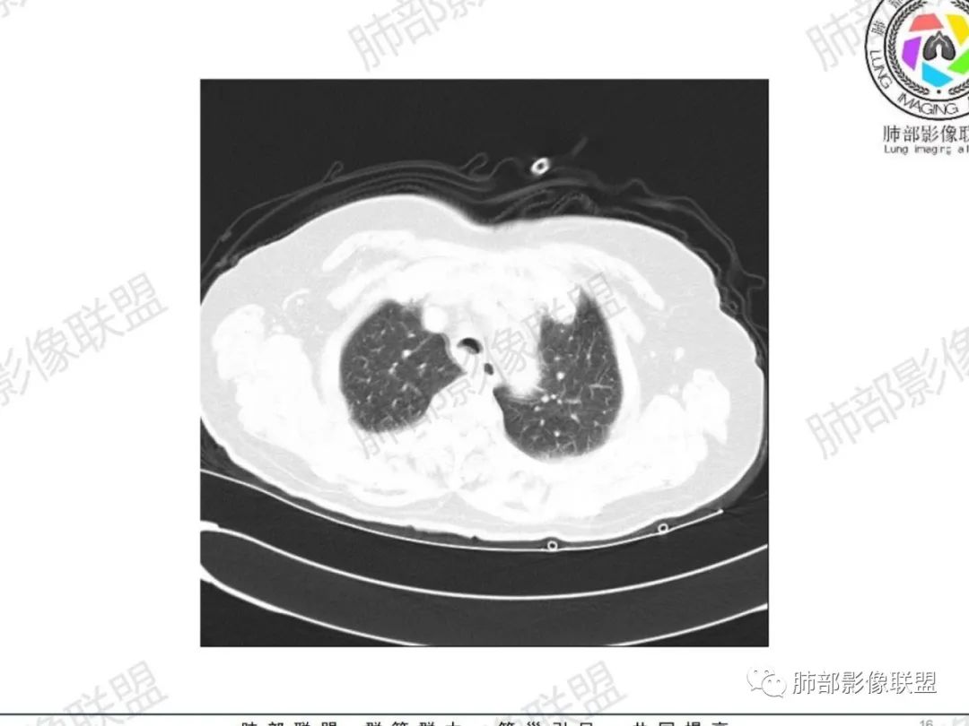 影像PPT - 【病例】气管腺样囊性癌1例CT影像讨论-9 影像PPT - 【病例】气管腺样囊性癌1例CT影像讨论-9