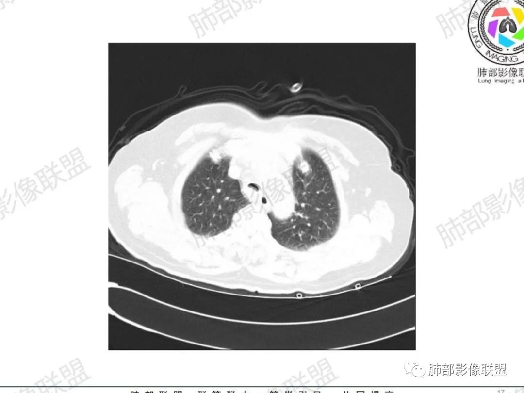 影像PPT - 【病例】气管腺样囊性癌1例CT影像讨论-10 影像PPT - 【病例】气管腺样囊性癌1例CT影像讨论-10