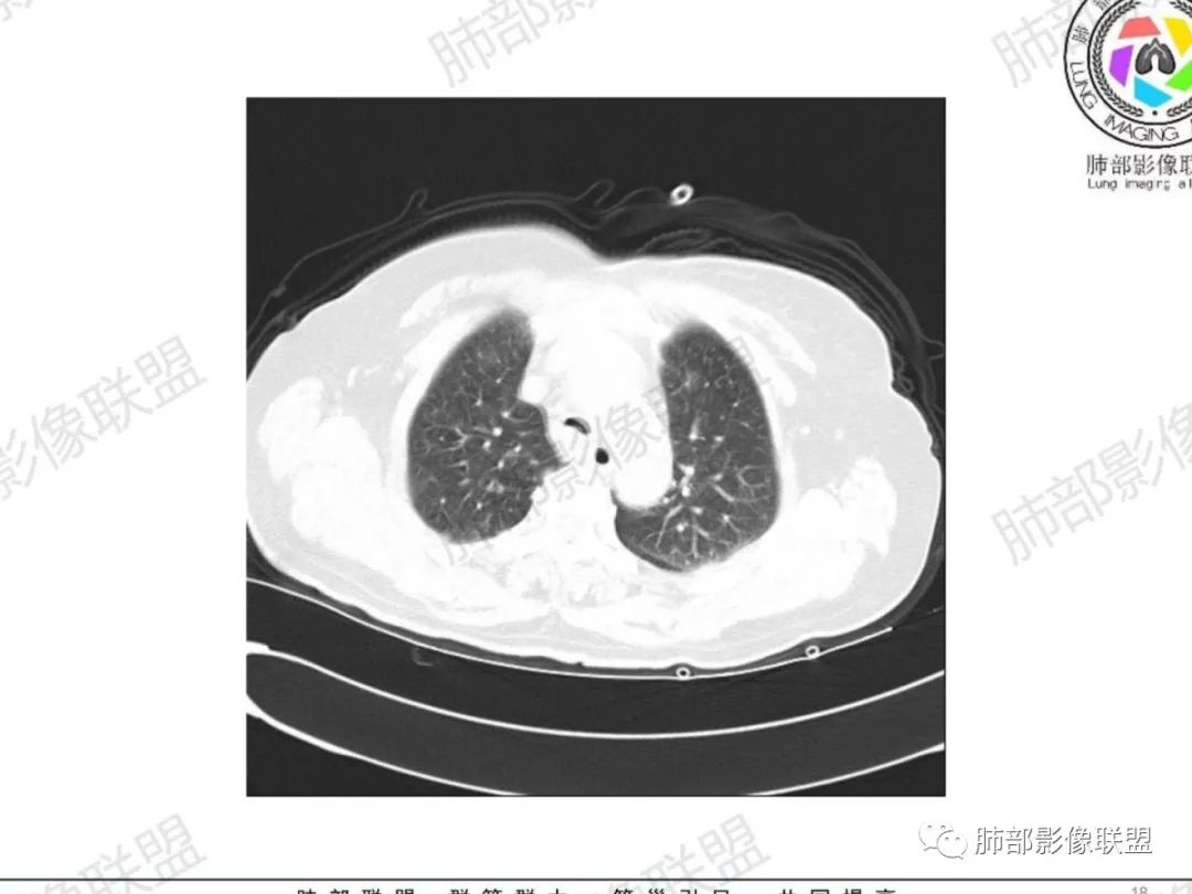影像PPT - 【病例】气管腺样囊性癌1例CT影像讨论-11 影像PPT - 【病例】气管腺样囊性癌1例CT影像讨论-11