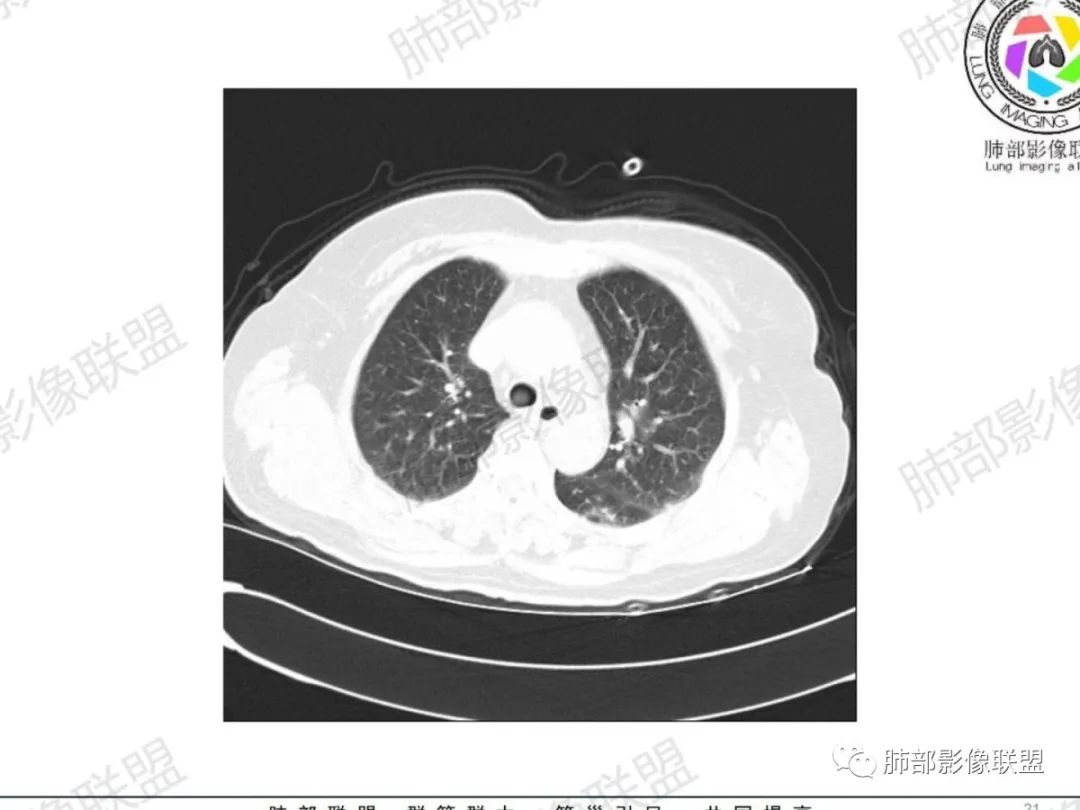 影像PPT - 【病例】气管腺样囊性癌1例CT影像讨论-14 影像PPT - 【病例】气管腺样囊性癌1例CT影像讨论-14
