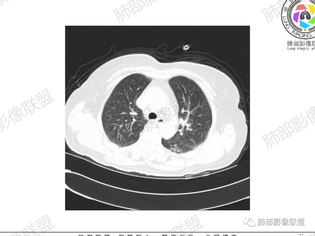 影像PPT - 【病例】气管腺样囊性癌1例CT影像讨论-15 影像PPT - 【病例】气管腺样囊性癌1例CT影像讨论-15