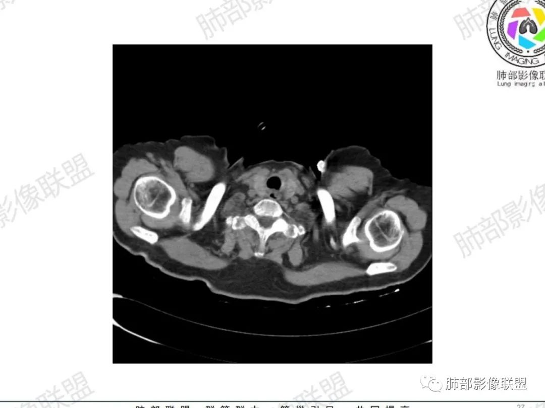 影像PPT - 【病例】气管腺样囊性癌1例CT影像讨论-16 影像PPT - 【病例】气管腺样囊性癌1例CT影像讨论-16
