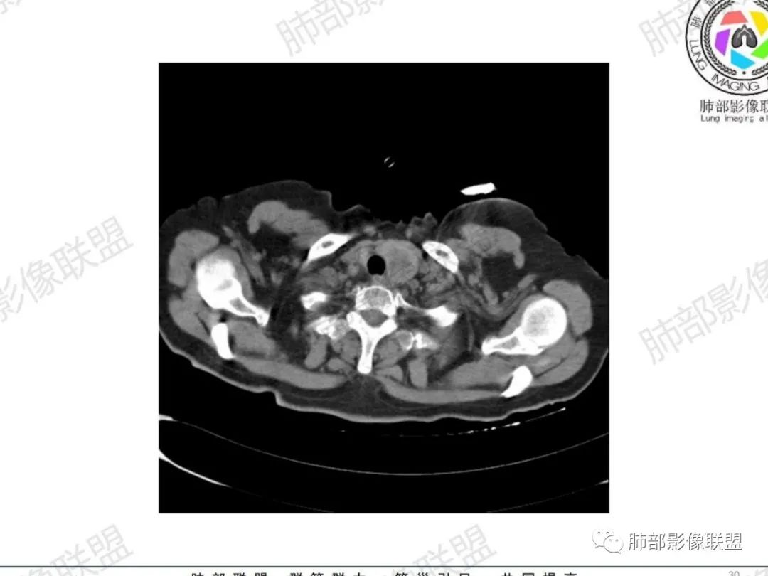 影像PPT - 【病例】气管腺样囊性癌1例CT影像讨论-19 影像PPT - 【病例】气管腺样囊性癌1例CT影像讨论-19