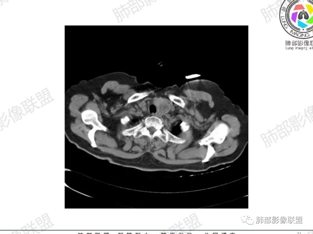 影像PPT - 【病例】气管腺样囊性癌1例CT影像讨论-20 影像PPT - 【病例】气管腺样囊性癌1例CT影像讨论-20