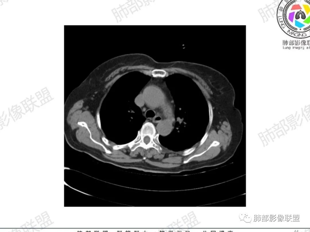 影像PPT - 【病例】气管腺样囊性癌1例CT影像讨论-33 影像PPT - 【病例】气管腺样囊性癌1例CT影像讨论-33