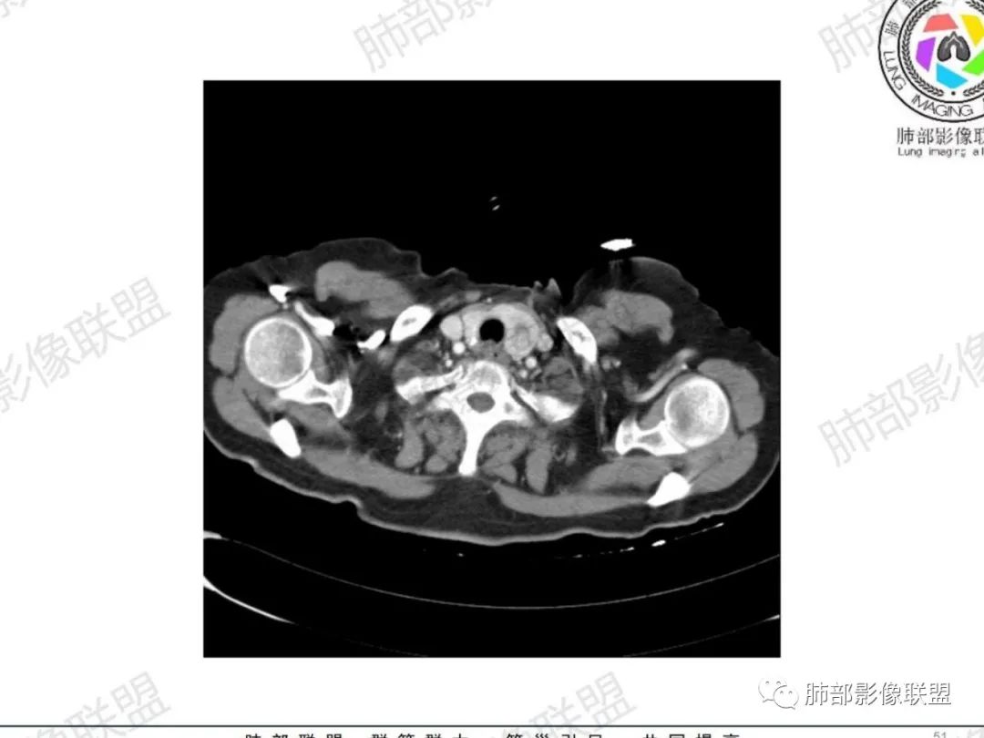 影像PPT - 【病例】气管腺样囊性癌1例CT影像讨论-36 影像PPT - 【病例】气管腺样囊性癌1例CT影像讨论-36