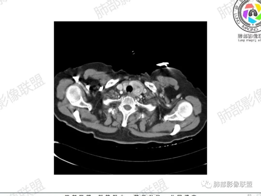 影像PPT - 【病例】气管腺样囊性癌1例CT影像讨论-37 影像PPT - 【病例】气管腺样囊性癌1例CT影像讨论-37