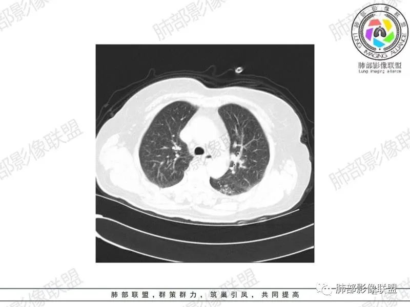 影像PPT - 【病例】气管腺样囊性癌1例CT影像讨论-74 影像PPT - 【病例】气管腺样囊性癌1例CT影像讨论-74