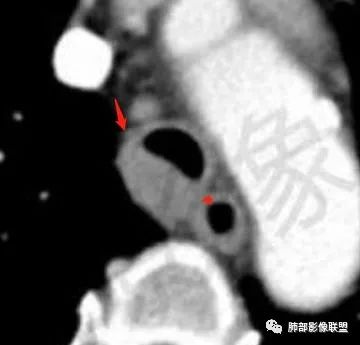 影像PPT - 【病例】气管腺样囊性癌1例CT影像讨论-79 影像PPT - 【病例】气管腺样囊性癌1例CT影像讨论-79