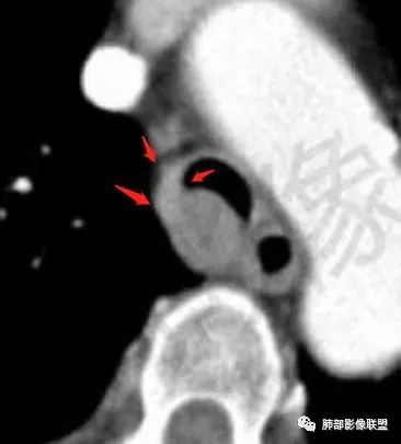 影像PPT - 【病例】气管腺样囊性癌1例CT影像讨论-80 影像PPT - 【病例】气管腺样囊性癌1例CT影像讨论-80