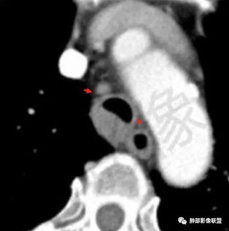 影像PPT - 【病例】气管腺样囊性癌1例CT影像讨论-81 影像PPT - 【病例】气管腺样囊性癌1例CT影像讨论-81