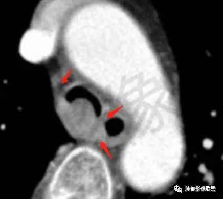 影像PPT - 【病例】气管腺样囊性癌1例CT影像讨论-82 影像PPT - 【病例】气管腺样囊性癌1例CT影像讨论-82
