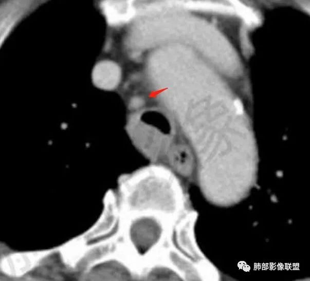 影像PPT - 【病例】气管腺样囊性癌1例CT影像讨论-86 影像PPT - 【病例】气管腺样囊性癌1例CT影像讨论-86