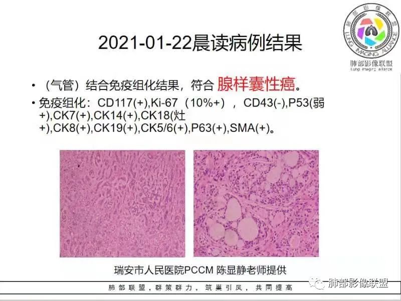 影像PPT - 【病例】气管腺样囊性癌1例CT影像讨论-88 影像PPT - 【病例】气管腺样囊性癌1例CT影像讨论-88