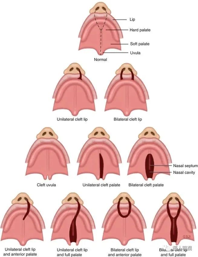 影像PPT - 原发腭、继发腭、硬腭、软腭的解剖-3 影像PPT - 原发腭、继发腭、硬腭、软腭的解剖-3