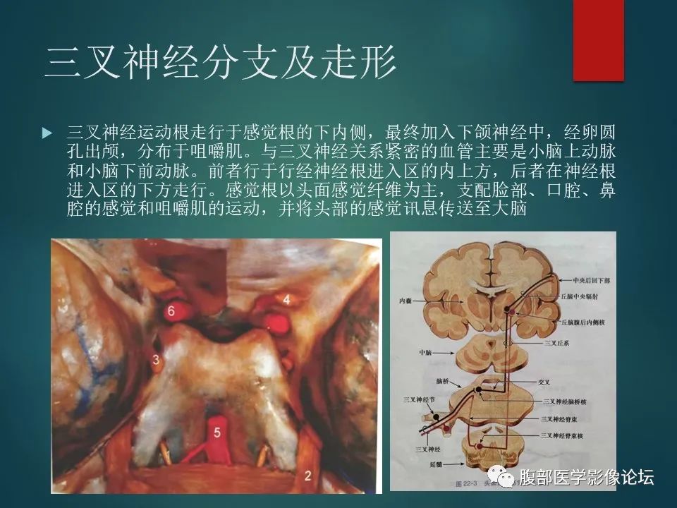影像PPT - 【PPT】三叉孔道弯弯绕-4 影像PPT - 【PPT】三叉孔道弯弯绕-4