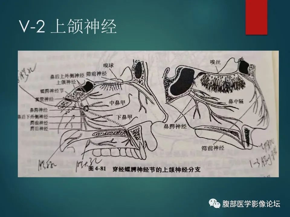 影像PPT - 【PPT】三叉孔道弯弯绕-16 影像PPT - 【PPT】三叉孔道弯弯绕-16